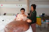 Врачи удалили вьетнамцу 90-килограммовую опухоль