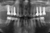 Процесс приживления зубных имплантатов удалось ускорить