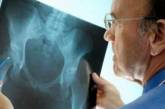 Врачи подсказали, как предотвратить остеопороз