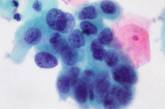 Ученые изобрели дешевый цветной тест для диагностики ВИЧ и рака 