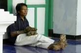 Индонезийского "человека-дерево" будут оперировать дважды в год