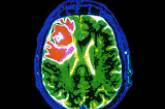Служебные клетки мозга способны вызывать эпилепсию