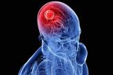 Медики назвали первые симптомы рака мозга