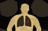 Туберкулез: что нужно знать?