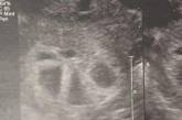 Беременная пятерняшками женщина устроила очаровательную фотосессию. ФОТО