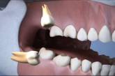 Стоматологи рассказали, нужно ли удалять зубы мудрости