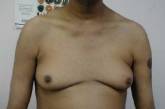 Британские мужчины стали вдвое чаще уменьшать грудь с помощью хирургов