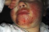 2-месячная малышка мучилась 8 месяцев из-за поцелуя родственника