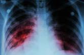 Другая сторона карантина: ученые предупреждают о вспышке туберкулеза и более чем миллион жертв