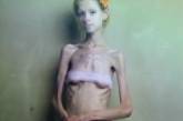 Молодая жительница Черкасской области умерла от анорексии: обнародованы жуткие фото