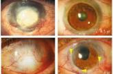 Стволовые клетки восстановили зрение десяткам пациентов с ожогами глаз