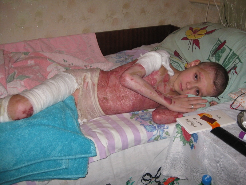 Николаевскому школьнику, получившему серьезные ожоги, нужны деньги на лечение
