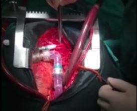 В Украине впервые пересадили механическое сердце