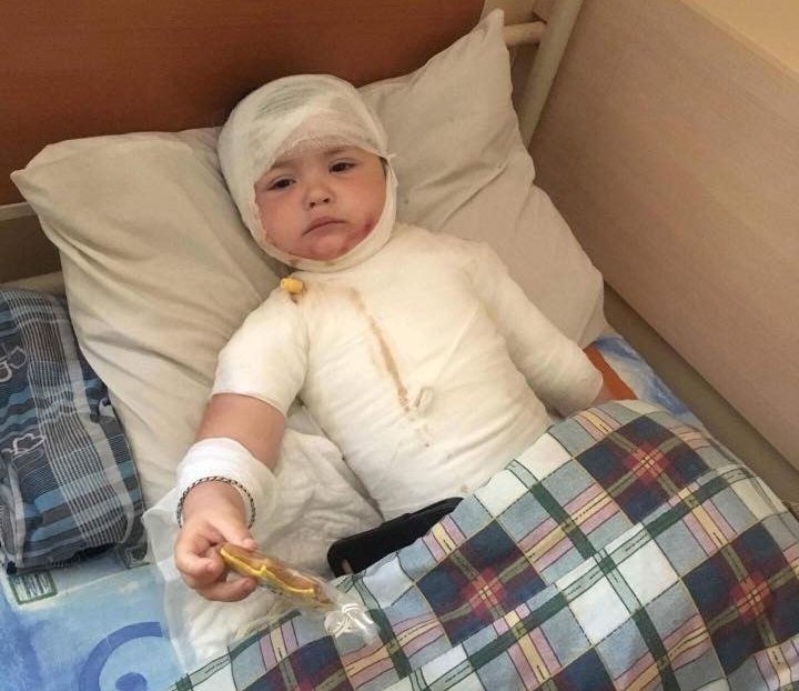 В Одессе двухлетняя девочка обварилась кипятком, перевернув на себя чайник