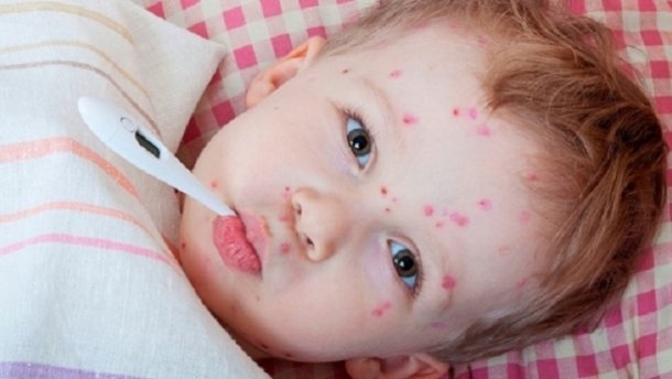 Из-за дефицита вакцин от кори за неделю на Закарпатье заболели более 150 человек