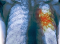 Одессе грозит эпидемия туберкулеза?