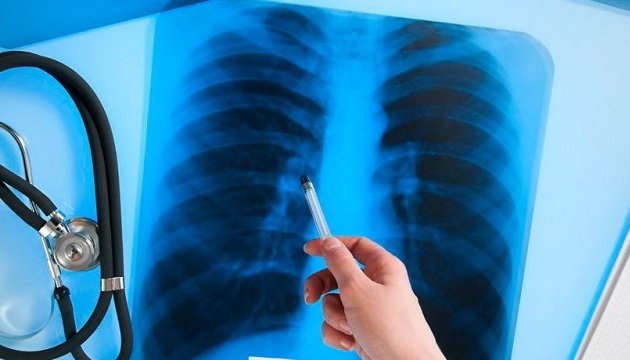В Украине уменьшилось число больных туберкулезом – МОЗ