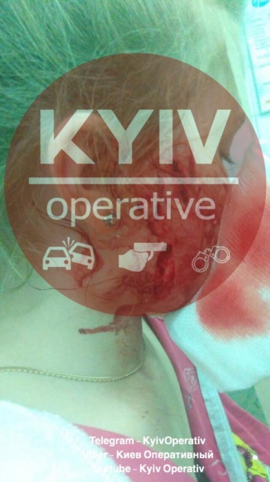 Под Киевом собака набросилась и искусала 8-летнюю девочку