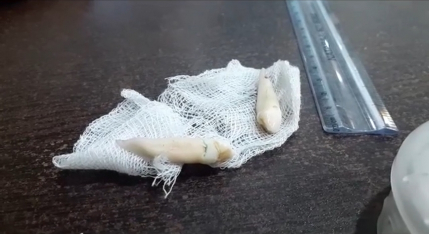 Стоматолог удалил самый длинный в мире человеческий зуб. Видео