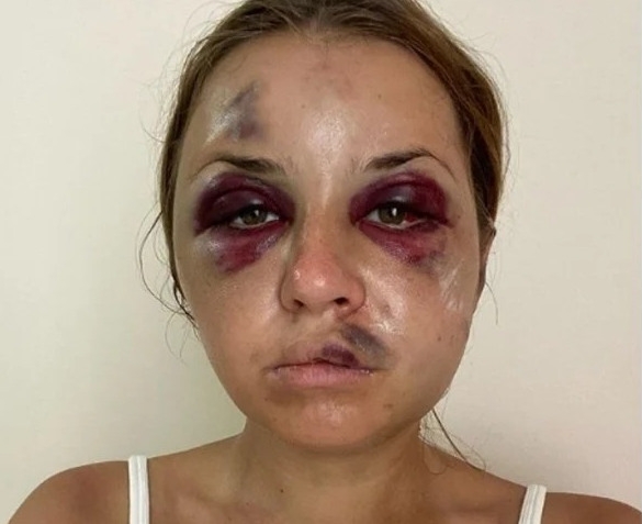 Анастасия Луговая после избиения в поезде