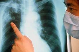 В МОЗ рассказали, как изменилась заболеваемость туберкулезом в августе