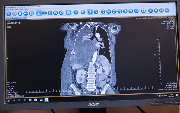 В Украине впервые удалили опухоль в 4,5 кг из грудной клетки