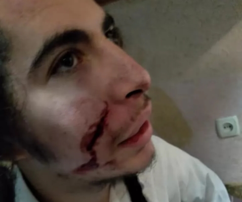 В Умани неизвестные напали на 17-летнего хасида и порезали ему лицо