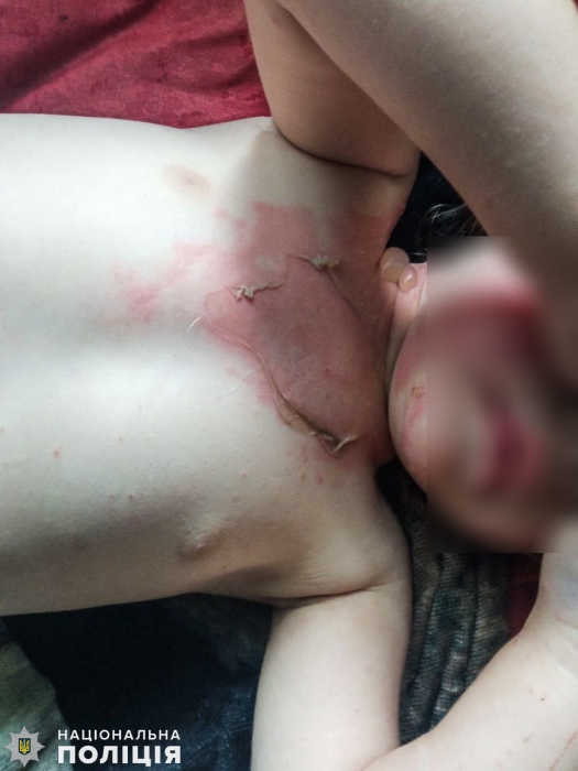В Николаевской области 2-летняя девочка вылила на себя кипяток – мать даже не пыталась помочь