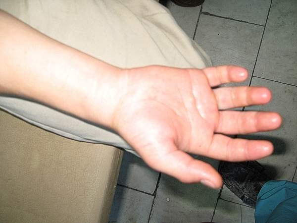 Рука Ирины после укуса опухла