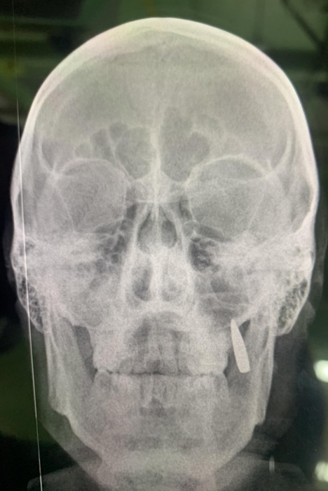 У бійця ЗСУ застрягла куля в зубах: він дізнався про неї лише після рентгену (фото)