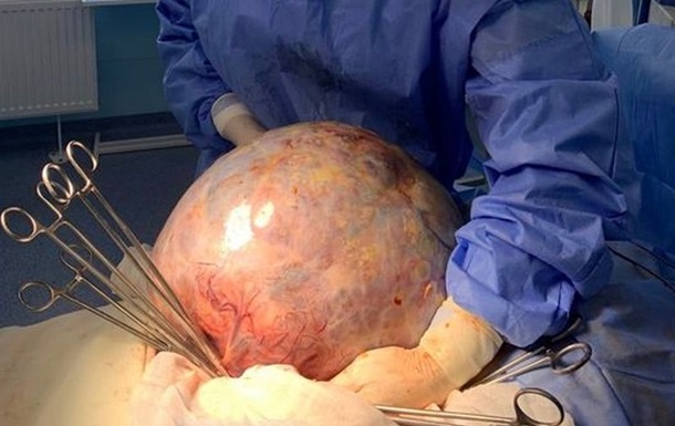 В Кропивницком онкологи удалили десятикилограммовую опухоль