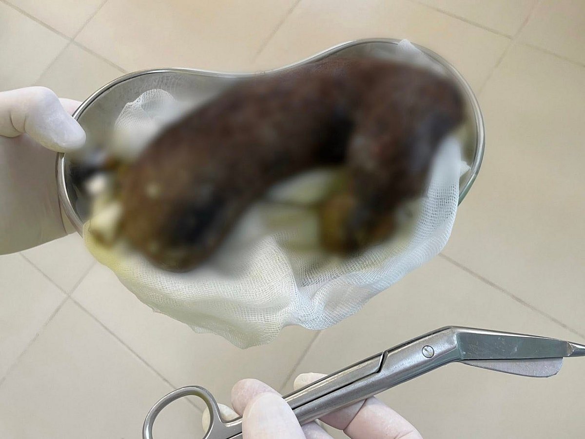 Во Львове врачи спасли 13-летнюю девочку с синдромом Рапунцель