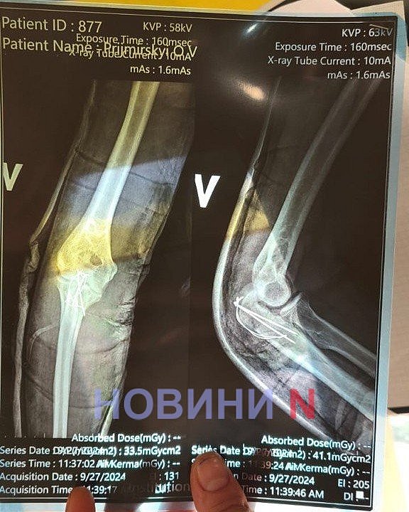 Доброволец из Николаева рассказал о реабилитации после избиения в учебной части ВСУ