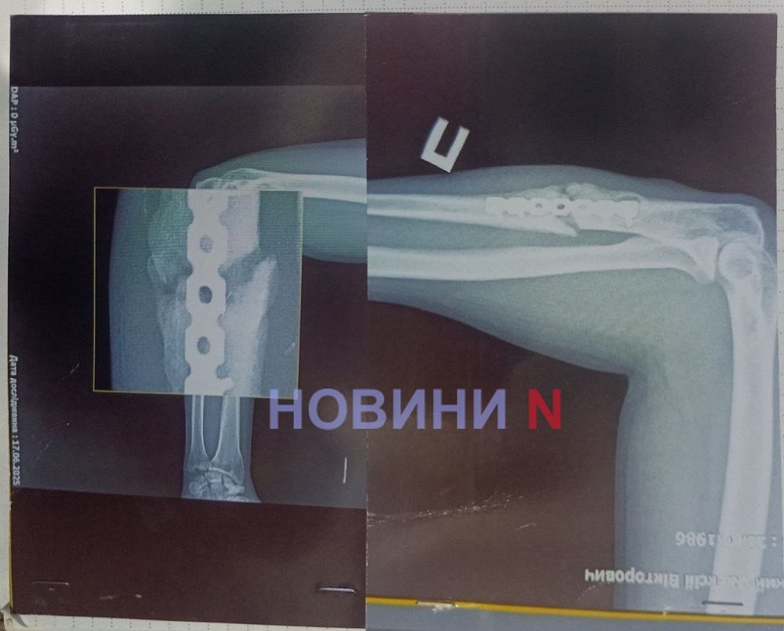 Доброволец из Николаева рассказал о реабилитации после избиения в учебной части ВСУ