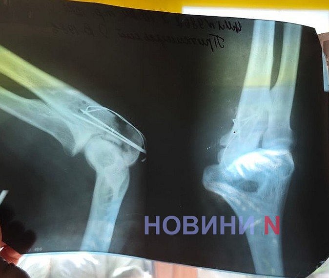 Доброволец из Николаева рассказал о реабилитации после избиения в учебной части ВСУ