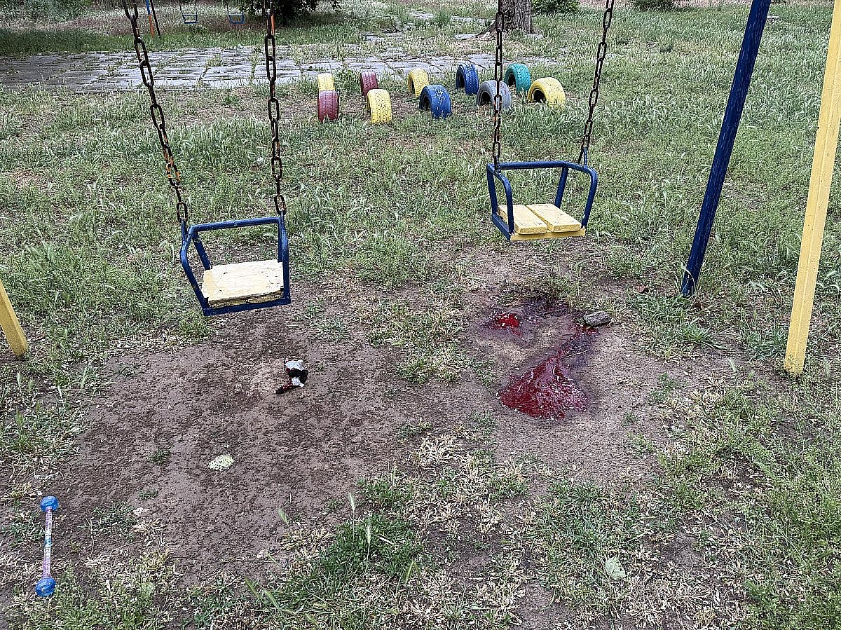 В Николаеве врачи удалили осколки из головы 3-летней девочки, пострадавшей от обстрела детской площадки в Херсоне