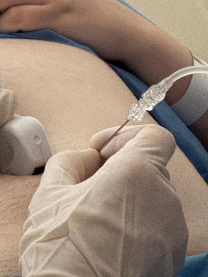 В Україні провели унікальну операцію дитині ще до її народження (фото)