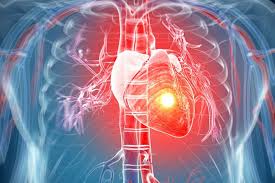 Симптомы острого инфаркта миокарда можно спутать с болью в спине &#8211; кардиолог