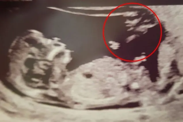 В Британии на снимке УЗИ беременной появился "ангел-хранитель"