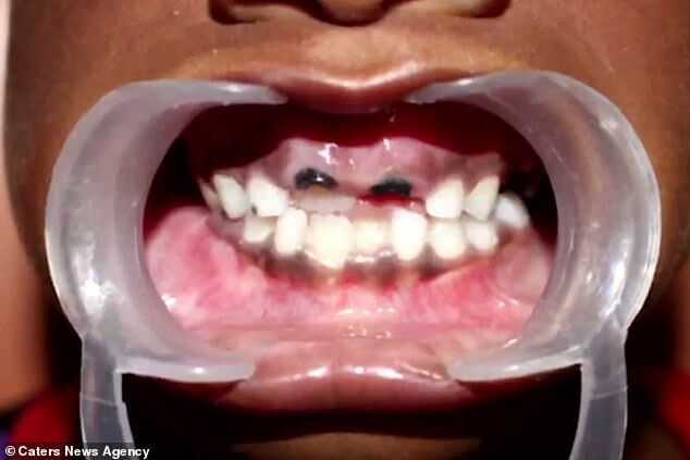 В Индии ребенку удалили 526 зубов: ужасающий фоторепортаж