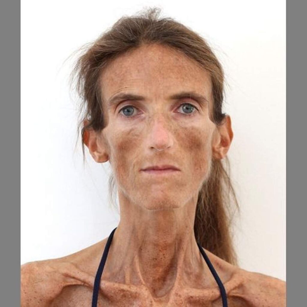 Найдена самая худая женщина в мире: как она выглядит. Фото