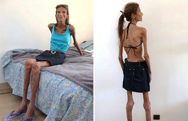 Найдена самая худая женщина в мире: как она выглядит. Фото
