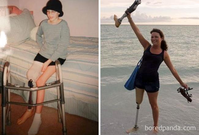 Они смогли победить рак: мощные снимки людей «до и после» (ФОТО)