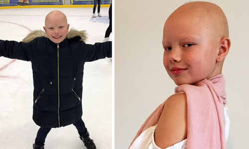 Дівчинка, яка втратила волосся через алопецію, дивиться на життя з оптимізмом і не хоче носити перуку (ФОТО)