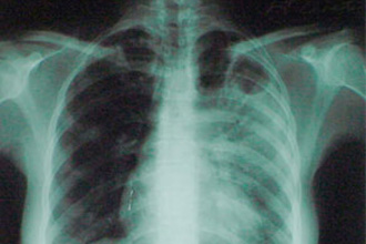 В Украине эпидемия туберкулеза