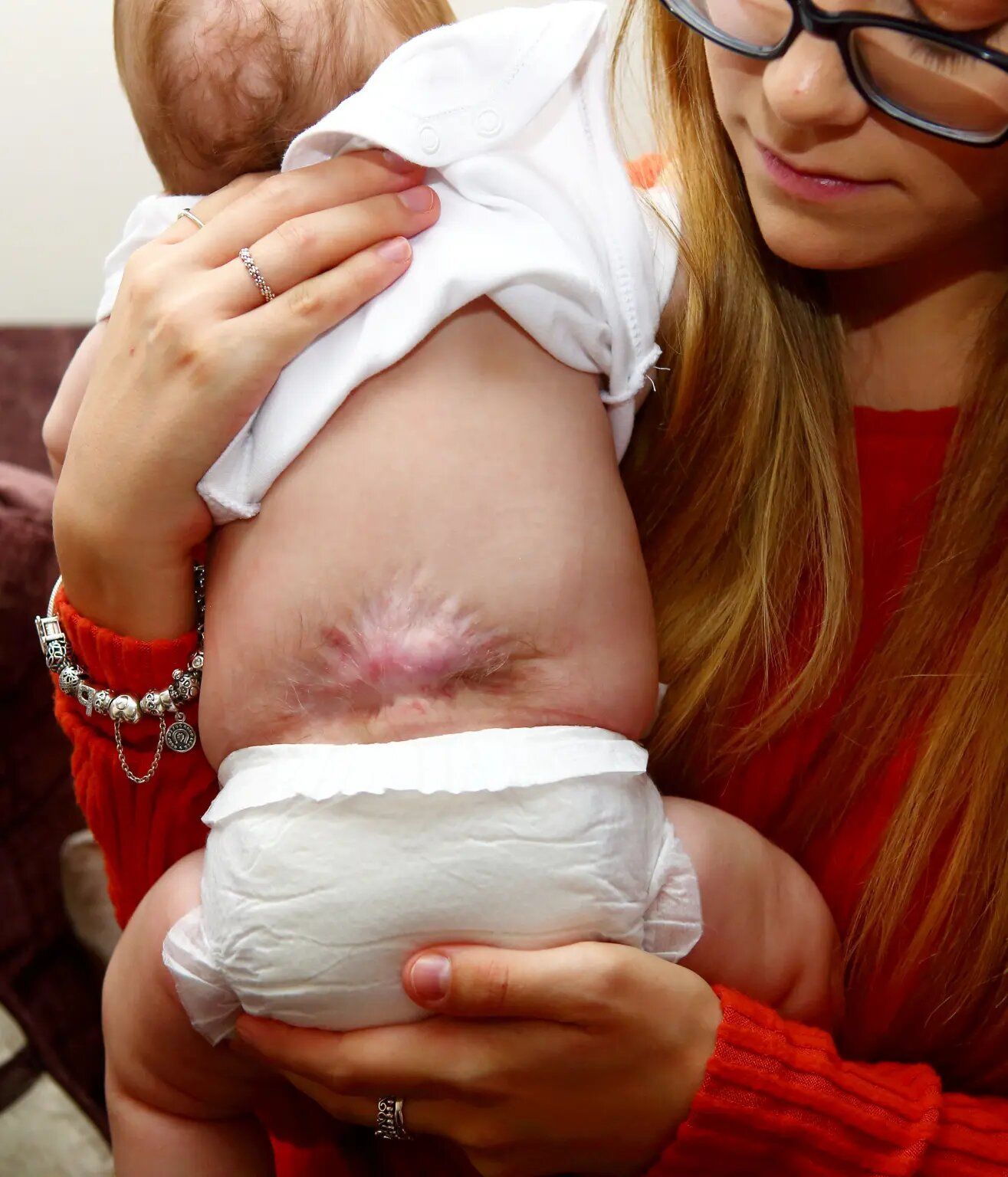 Дитині зробили операцію на хребті в утробі матері / © SWNS