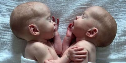 Сіамських близнючок роз'єднали під час ризикованої 4-годинної операції: фото, подробиці