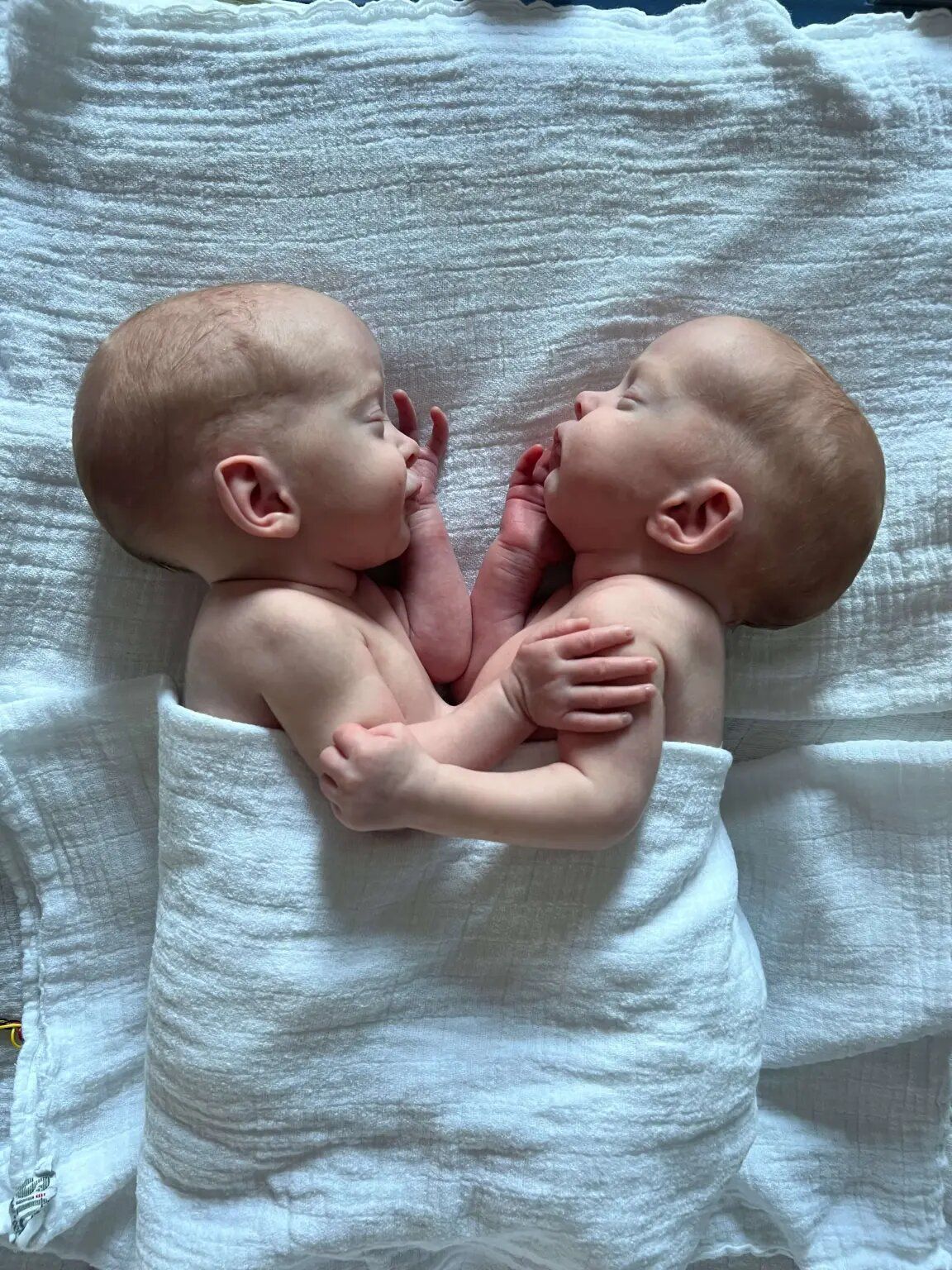 Сіамські близнючки / Фото: University Hospital Hamburg-Eppendorf / © 