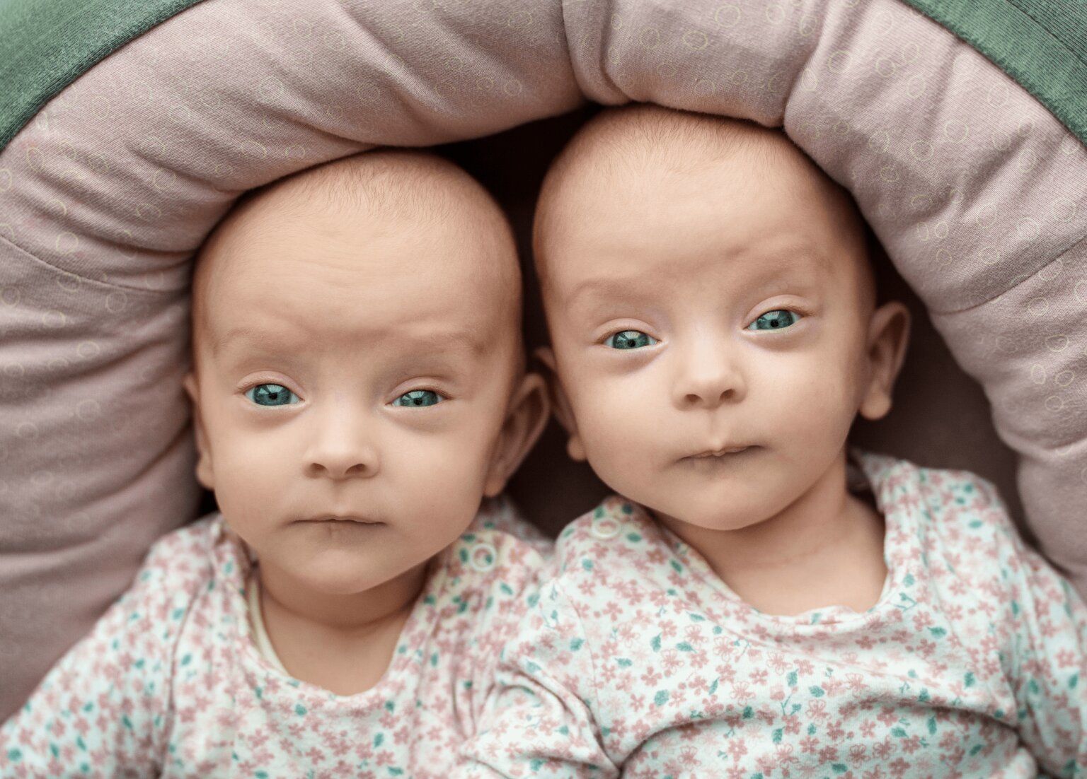 Сіамські близнючки / Фото: University Hospital Hamburg-Eppendorf / ©