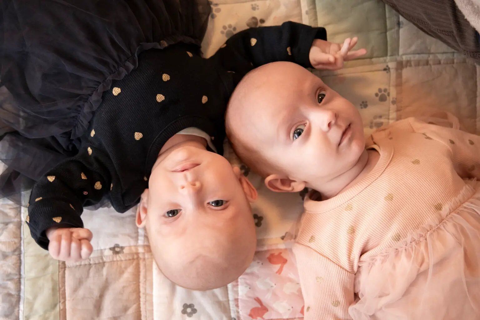 Сіамські близнючки / Фото: University Hospital Hamburg-Eppendorf / © 